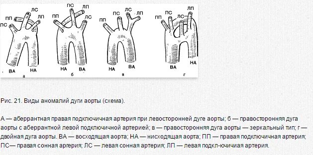 Аномалии ветвления дуги аорты. Аномалии отхождения ветвей дуги аорты. Аномалии отхождения сосудов дуги аорты. Вариантная анатомия дуги аорты.