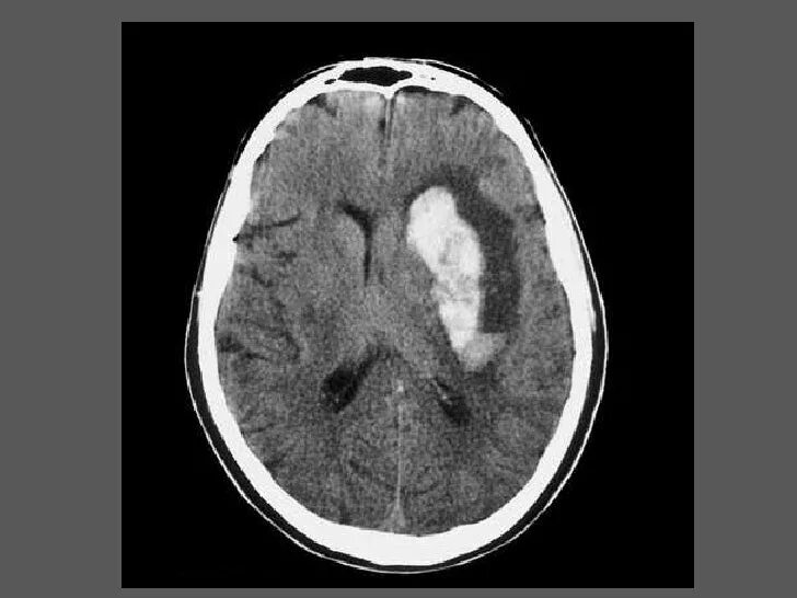 Кровоизлияние в желудочки. Глиома головного мозга кт. Кровоизлияние в опухоль головного мозга на кт. Геморрагический инсульт головного мозга мрт головного мозга. Ишемический инсульт с геморрагическим пропитыванием на кт.