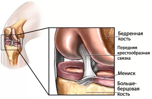 Разрыв связок ПКС коленного сустава. Мениски коленного сустава анатомия разрыв. Разрыв связок коленного сустава мениска мениска. Травма связок, мениска коленного сустава. Дегенеративные изменения крестообразных связок коленного сустава