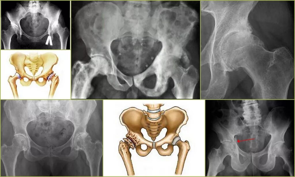 Деформирующий остеоартроз тазобедренных суставов 2. Коксартроз 2 степени тазобедренного сустава что это такое. Протрузионный коксартроз. Артрит артроз тазобедренных суставов