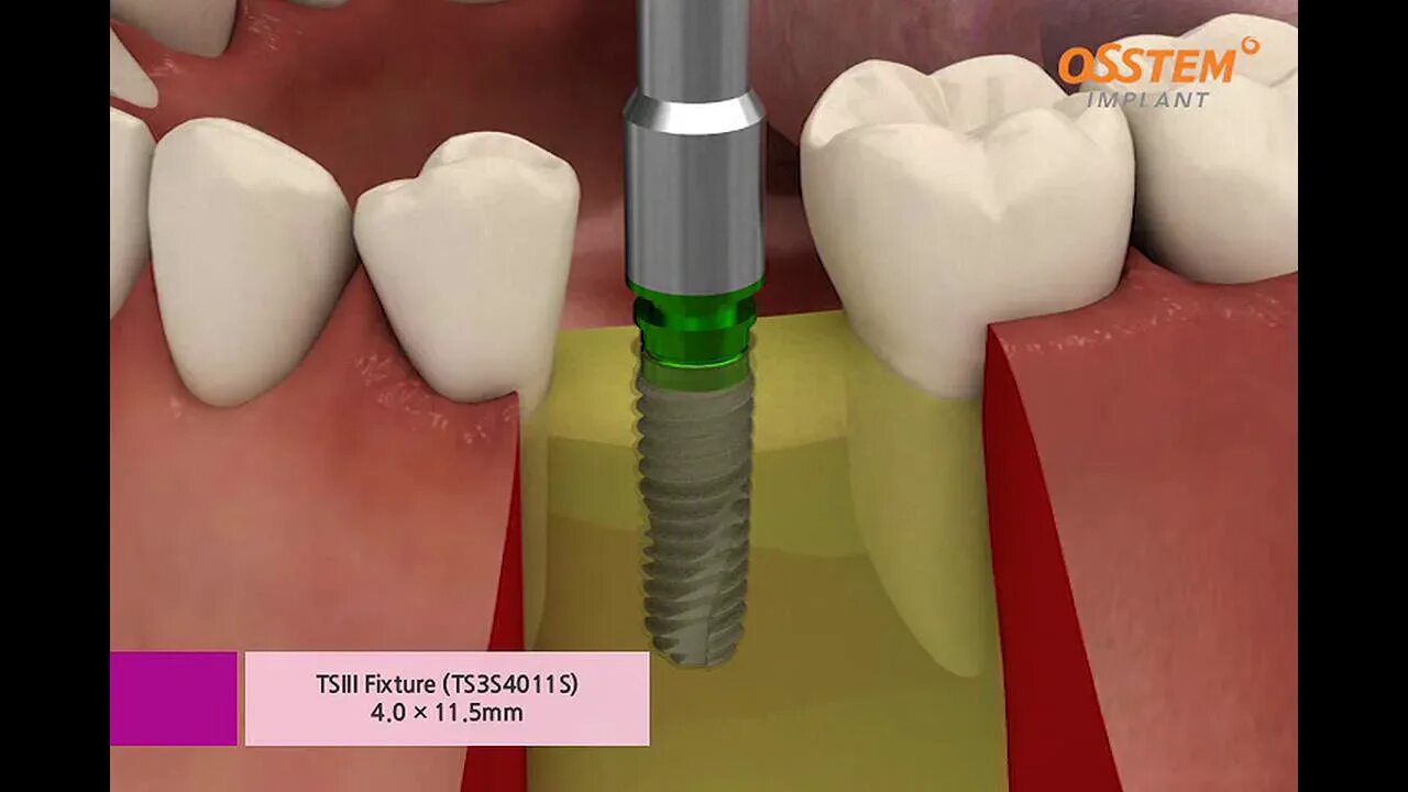 Имплантат Osstem Hiossen. Osstem TS III sa имплантат. Осстем имплантаты ts3. Импланты Osstem (Южная Корея). Hard bone