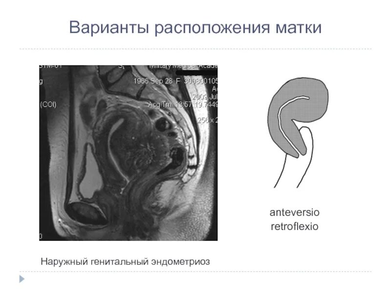 Положение матки. Anteversio flexio матки. положение тела матки. варианты расположения матки. расположение матки anteversio.