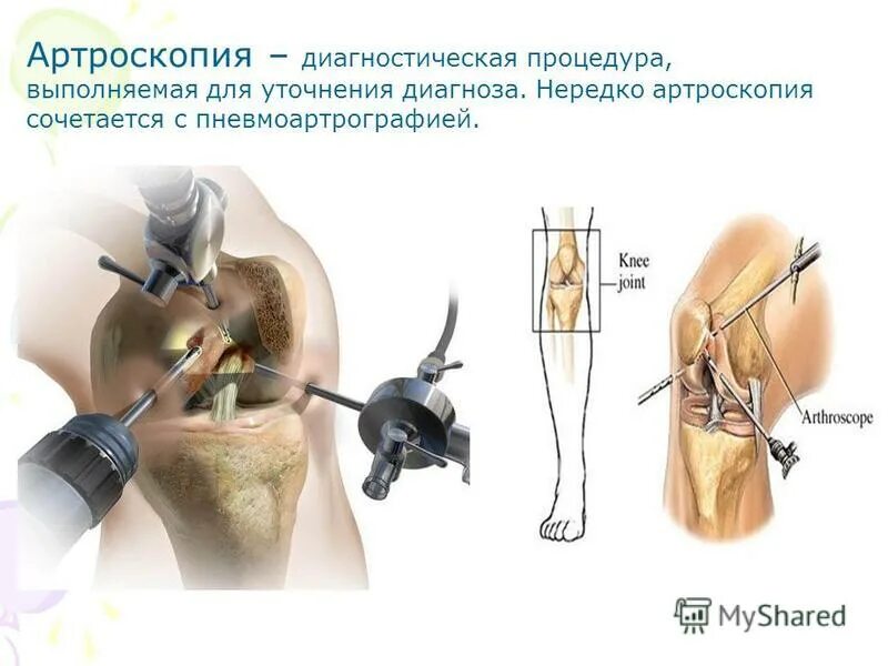 Можно ли делать артроскопию