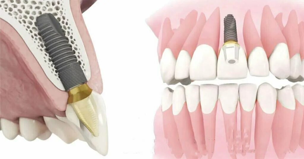 Рекомендации по установке имплантов. Для всех. Часть V. - IMPLANT-IN.COM - дента