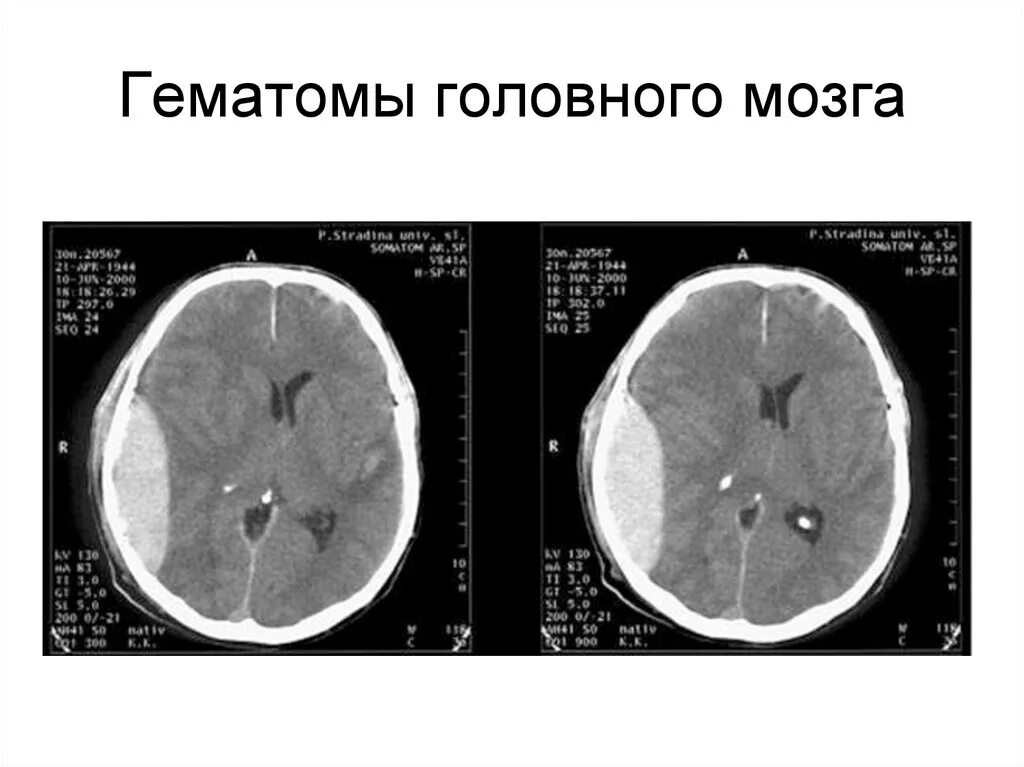 Как отличить гематому