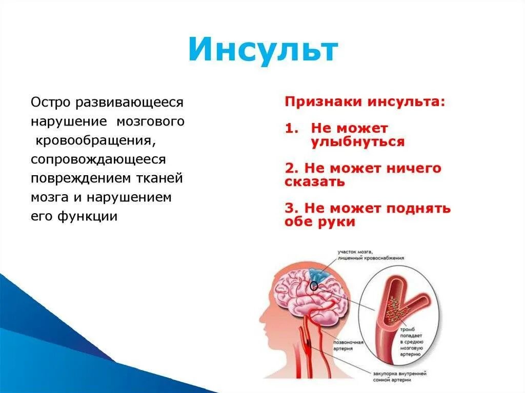 Признаки микроинсульта у женщины перенесенного. Инсульт. Признаки инсульта. Инсульт симптомы. Инсульт симптомы первые.