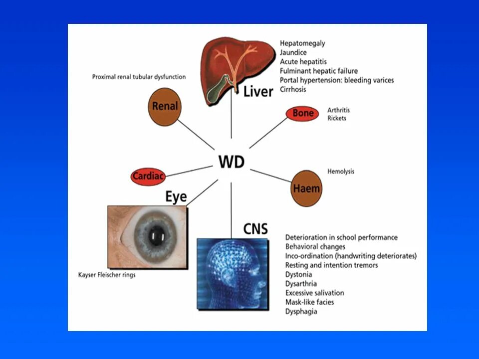 Болезнь Вильсона Коновалова патогенез. Болезнь Вильсона Коновалова схема. Болезнь Вильсона Коновалова частота встречаемости. Болезнь Вильсона Коновалова патогенез схема. Синдром вильсона коновалова что это такое простыми