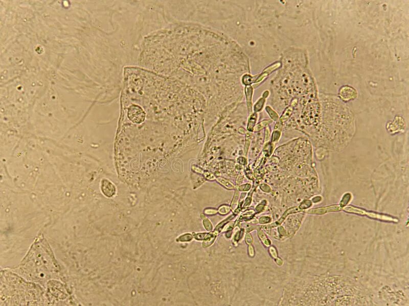 Дрожжевые клетки в моче повышены. Грибок в моче. Дрожжевые клетки в моче под микроскопом. Дрожжевые грибы в моче. Споры дрожжевого грибка в моче.