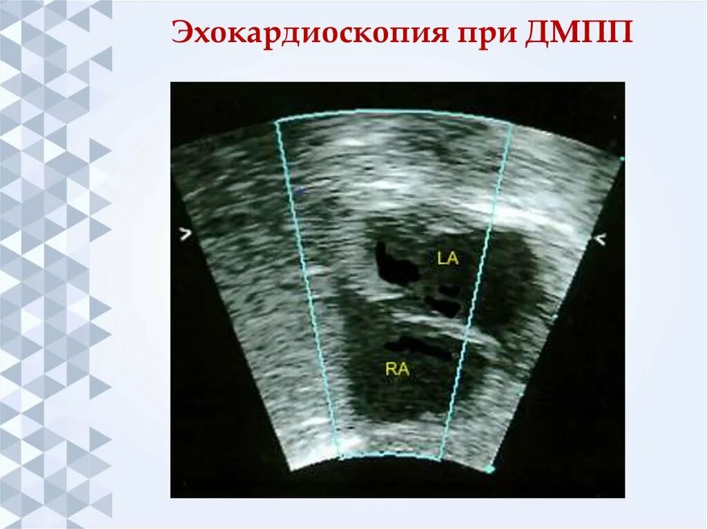 Функционирующее овальное. Открытое овальное окно на УЗИ сердца. Открытое овальное окно на ЭХОКГ. Овальное окно в сердце УЗИ. Эхо кг открытое овальное окно.