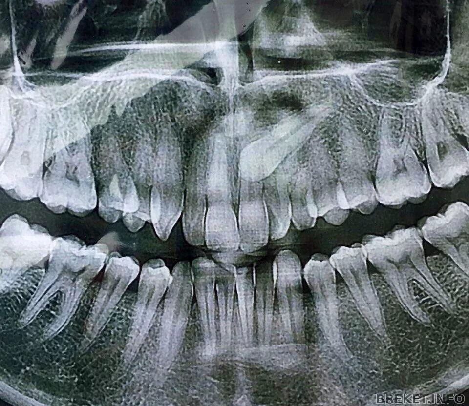 Ретинированный клык рентген. Ретинированный клык ОПТГ. Ретинированный зуб снимок. Ретинированный зуб на верхней челюсти. Клык фото зуба