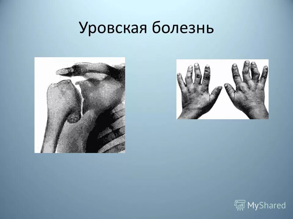 гипокальциемия симптомы. стадия продромы заболевания. уровская болезнь. уровская болезнь забайкалье. болезнь кашина-бека уровская.