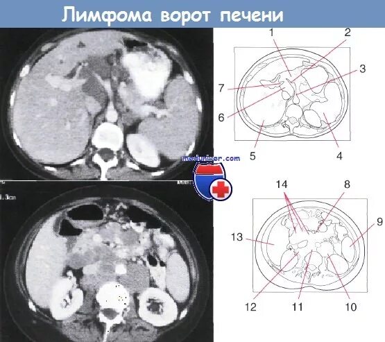 Образование в воротах печени. Лимфатические узлы печени на кт. Лимфатические узлы ворот печени. Лимфоузлы ворот печени кт.