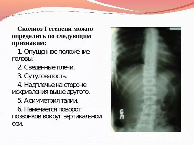 Сколиоз получить инвалидность. Сколиоз позвоночника 3 степени инвалидность. сколиоз 2 степени военное училище. сколиоз 2 градуса норма.