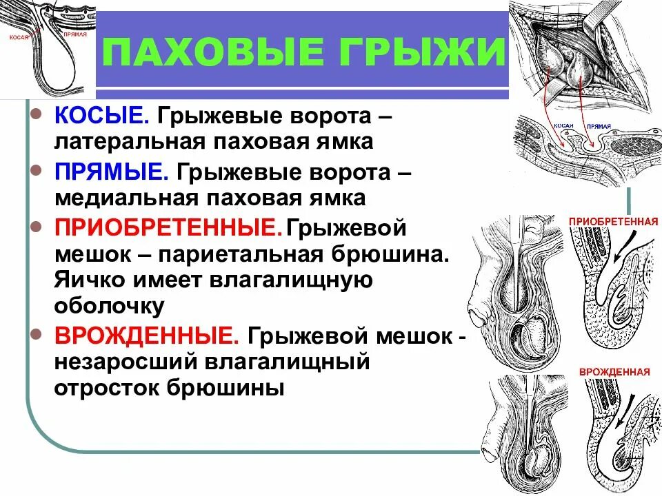 Врожденные паховые грыжи. Косая паховая грыжа у мужчин. Прямая и косая паховые грыжи