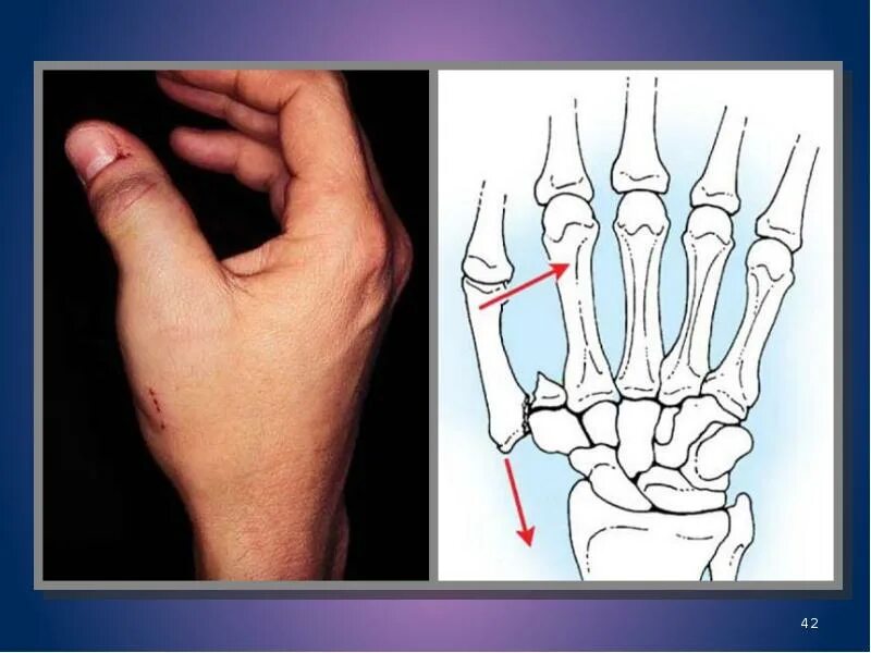Перелом Беннета 1 пястной кости. Перелом Беннета со смещением. Перелом первой пястной кости перелом Беннета. Как понять что у тебя трещина