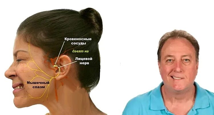 Картинки ЗАЩЕМЛЕНИЕ ТРОЙНИЧНОГО НЕРВА ЛЕЧЕНИЕ