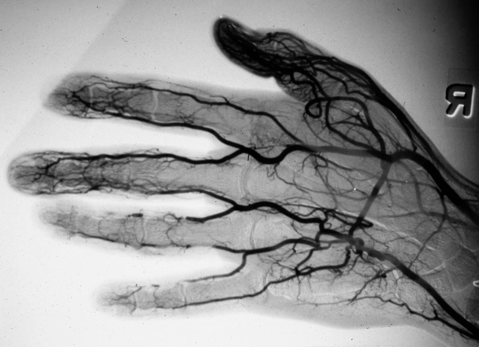 кровоснабжение лучезапястного сустава. кт ангиография верхних конечностей. кровоснабжение лучезапястного сустава. кровеносные сосуды кисти руки. вена кровеносный сосуд.