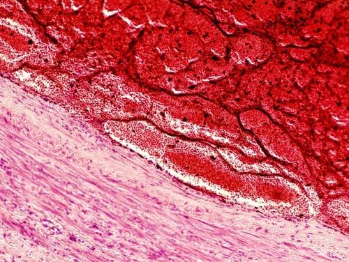 Смешанный тромб. Красный тромб микропрепарат. Красный тромб патанатомия. Гиалиновый тромб гистология. Гиалиновый тромб патологическая анатомия.