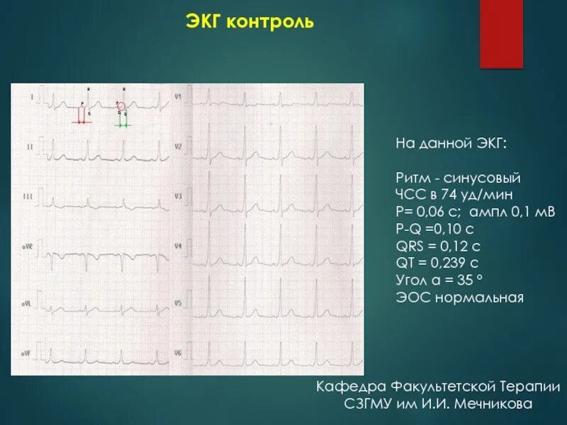 Чсс эос. Экг с расшифровкой синусовый ритм с чсс57. экг синусовый ритм эос нормальная. результат экг расшифровка синусовый ритм эос. экг ритм синусовый чсс 676.