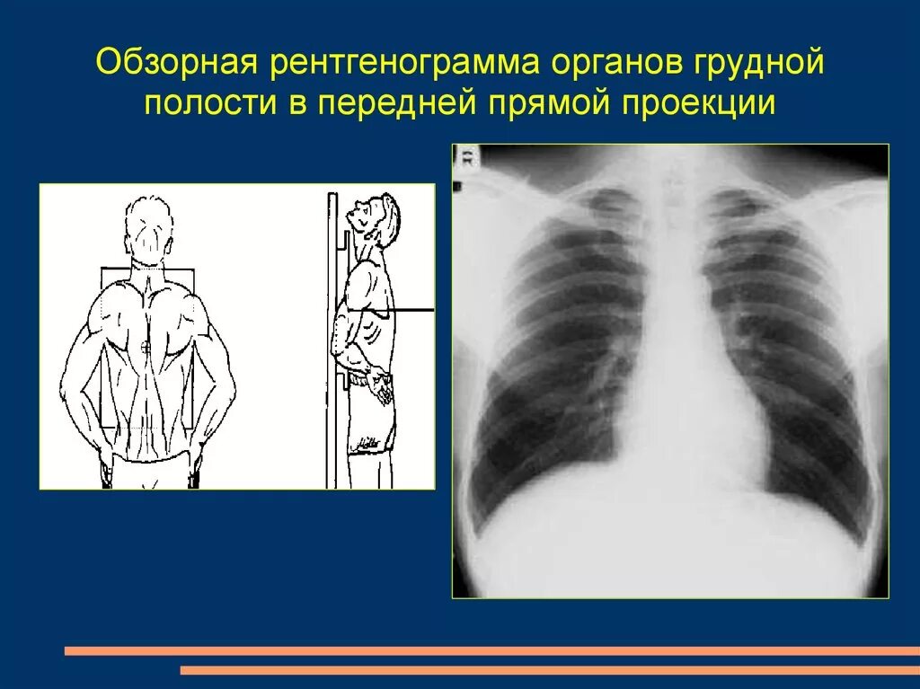 Прямая задняя проекция грудной клетки рентген. Грудная клетка в передней прямой проекции рентген. Передне задняя проекция рентген легких. Рентген легких в передней и задней проекции. Легкие в прямой проекции