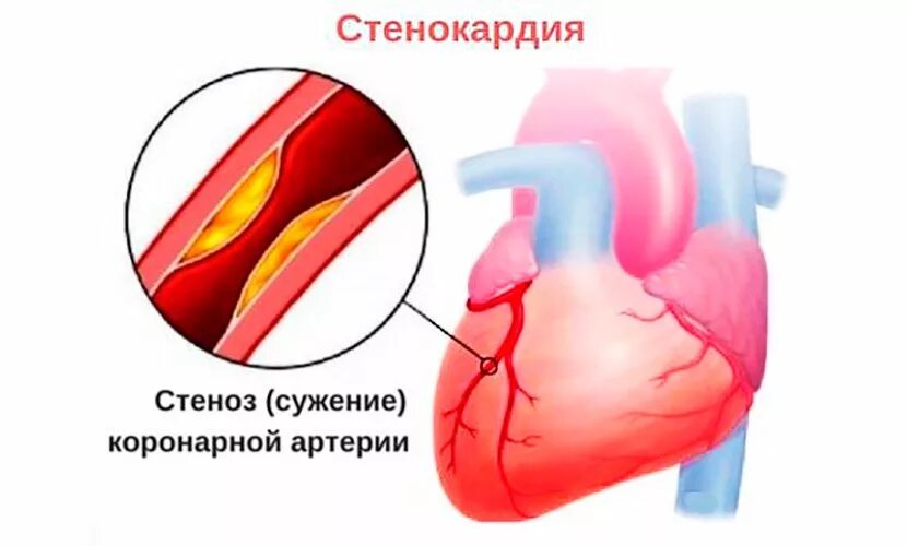 Спазм сердца. Спазм периферических сосудов. сужение коронарных сосудов.