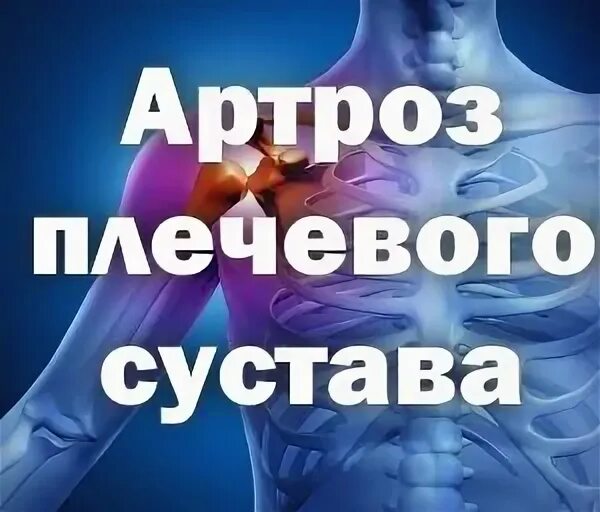 Артроз плечевого сустава мкб 10