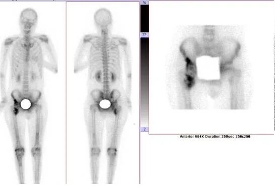Сцинтиграфия костей где сделать. Остеосцинтиграфия метастазы. Сцинтиграфия костей метастазы. Сцинтиграфия скелета норма. Сцинтиграфия полипозиционная костей.