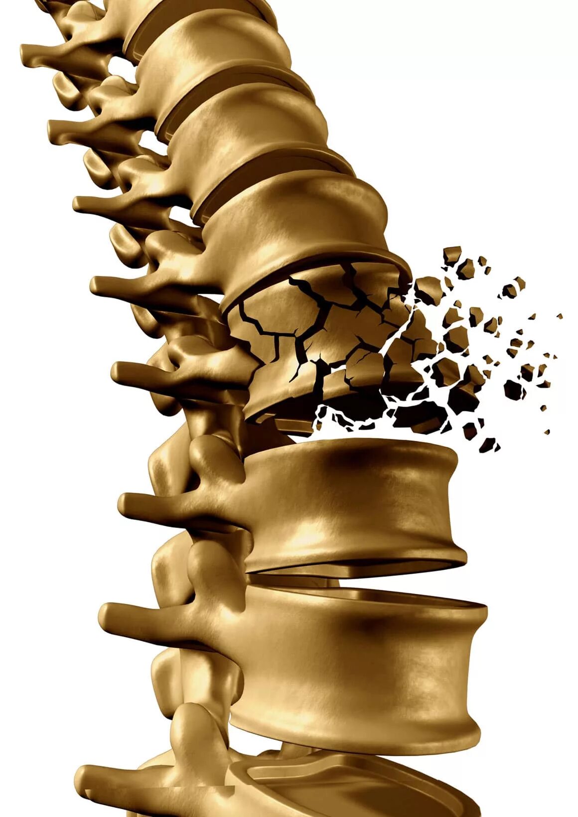 Остеопороз. Ломкость костей. Позвоночник вектор.