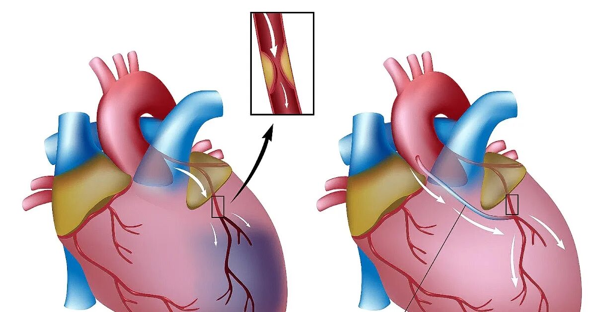 Коронарное шунтирование сосудов сердца. Шунтирование коронарных артерий сердца. Аортокоронарное шунтирование (АКШ). Аорта коронарное шунтирование. Что такое шунтирование сердца и сосудов