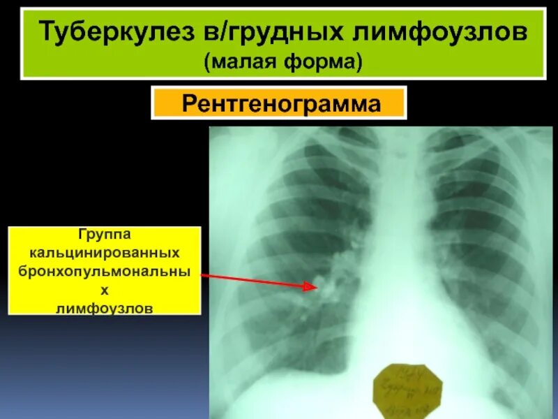 Туберкулез молочной. Малая форма туберкулеза внутригрудных лимфатических узлов. Туберкулез грудных лимфатических узлов. Туберкулез внутригрудных лимфатических узлов рентгенограмма. Туберкулез внутригрудных лимфоузлов малая форма.