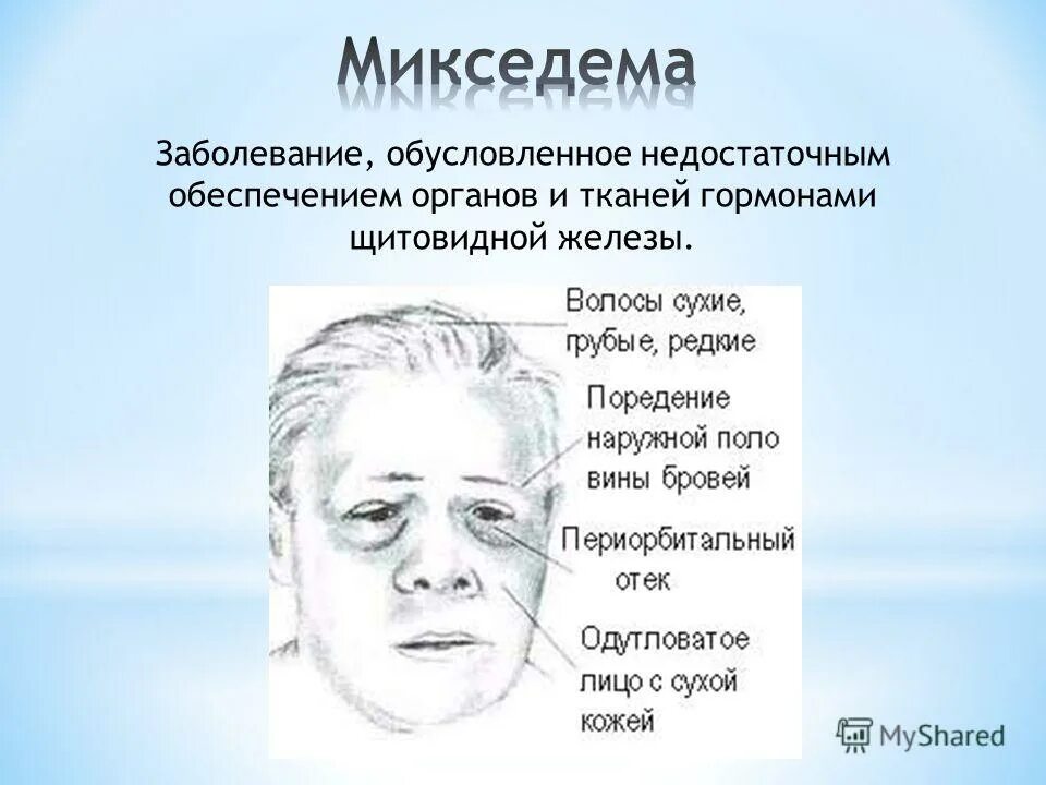 микседема слизистый отек.