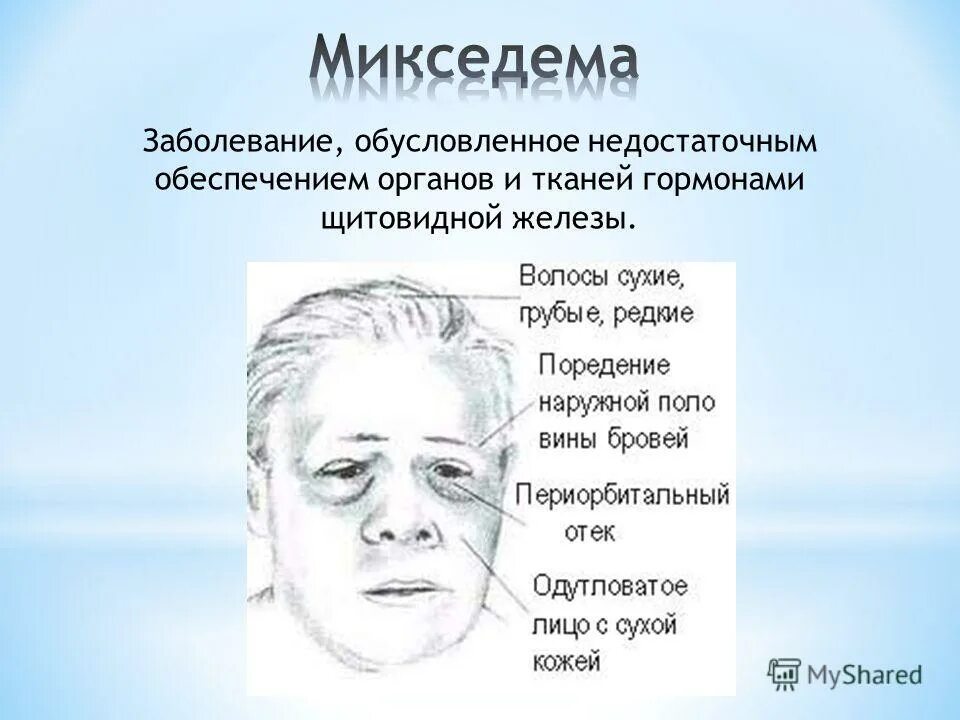 Микседема и базедова болезнь. Гормоны щитовидной железы при микседеме. Болезни щитовидной железы микседема. Микседема что за болезнь