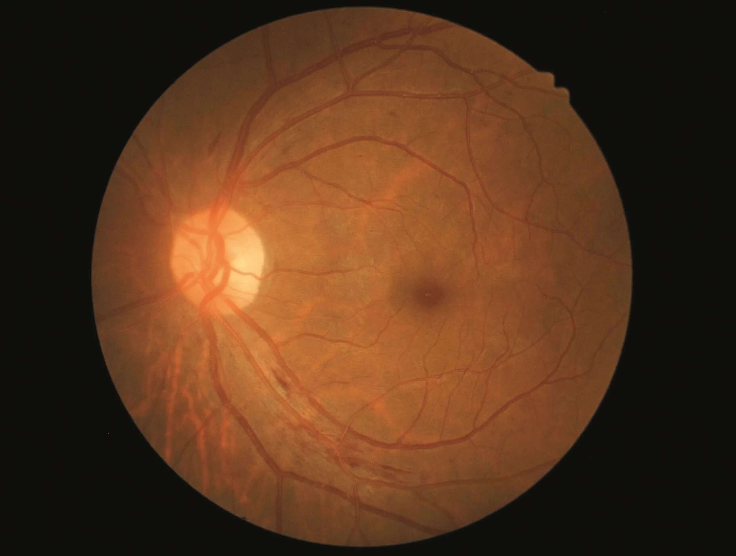 Montagen retinal platina. Пигментный ретинит сетчатки. Montagen retinal platina. Микрокистозная дегенерация сетчатки. Оптическая нейропатия лебера.