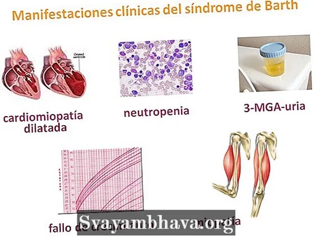 Bart-Pumphrey Syndrome; baps. Синдром Барта–Памфри (BPS). Синдром барта