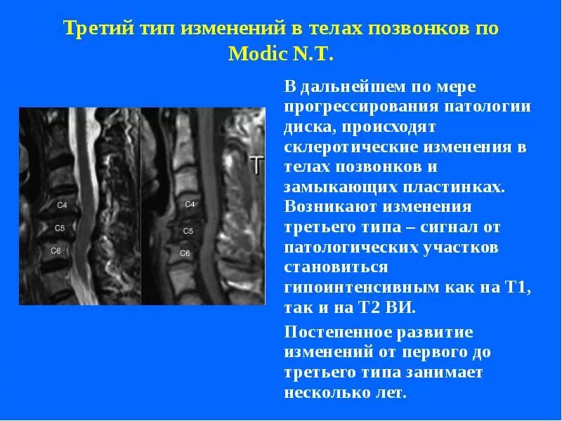 Изменения 3. Жировая дегенерация позвонков на мрт. изменения позвонков по типу модик. замыкающие пластинки тел позвонков. склеротические изменения в позвоночнике.