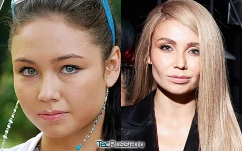 Ляйсан утяшева пластика