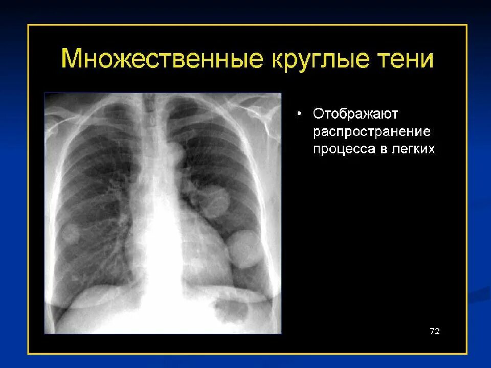 Множественные округлые. Круглая тень на рентгенограмме. Множественные круглые тени в легких. Округлая тень в корне легкого на рентгене.