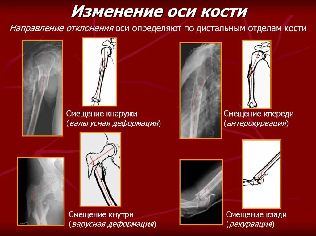 Изм оси. Лучевая семиотика заболеваний опорно-двигательного аппарата. Изменения оси кости по дистальным. Смещение костей по оси.