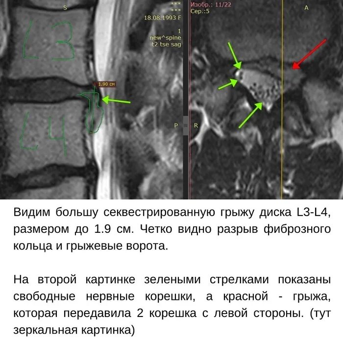 Каудальная миграция грыжи диска. Грыжа диска l3-l4. резорбция грыжи схематично. уменьшение межпозвоночной грыжи.