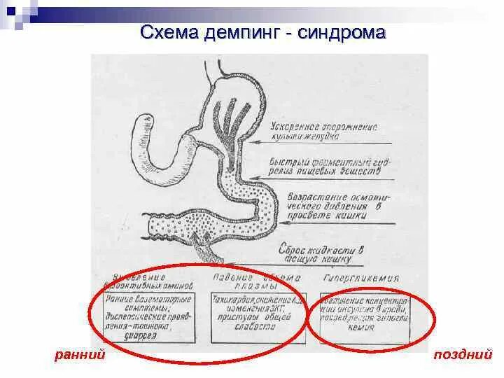 Демпинг синдром после резекции желудка. Демпинг синдром при бильрот 1. патогенез демпинг синдрома патофизиология. демпинг синдром клинические рекомендации после резекции желудка. реконструктивные операции при демпинг-синдроме.