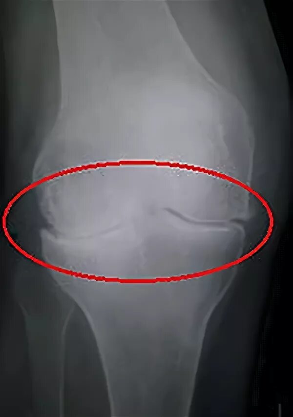 Латерализация надколенника. Хондропатия коленного сустава рентген. Хондропатия надколенника рентген. Латерализация надколенника рентген.