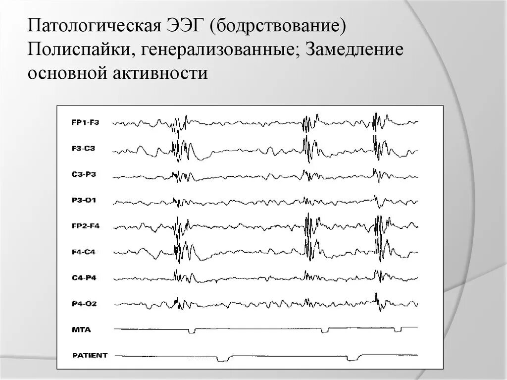 Спайки на ээг. Изолиния на ЭЭГ. Патологическая форма активности ЭЭГ:. ЭЭГ волны патологические. ЭЭГ головного мозга показатели.