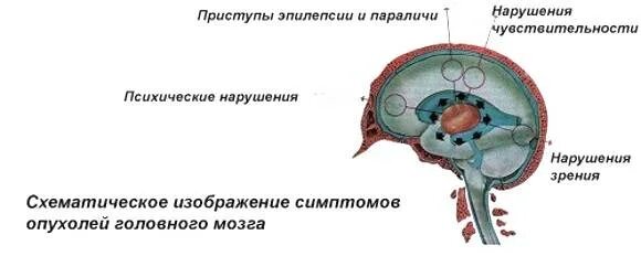 Симптомы опухоли головного мозга на ранних стадиях. Первичные и вторичные опухоли головного мозга. Опухоль головного мозга симптомы. Признаки опухоли головного мозга. Опухоль головного мозга симптомы на ранних стадиях.