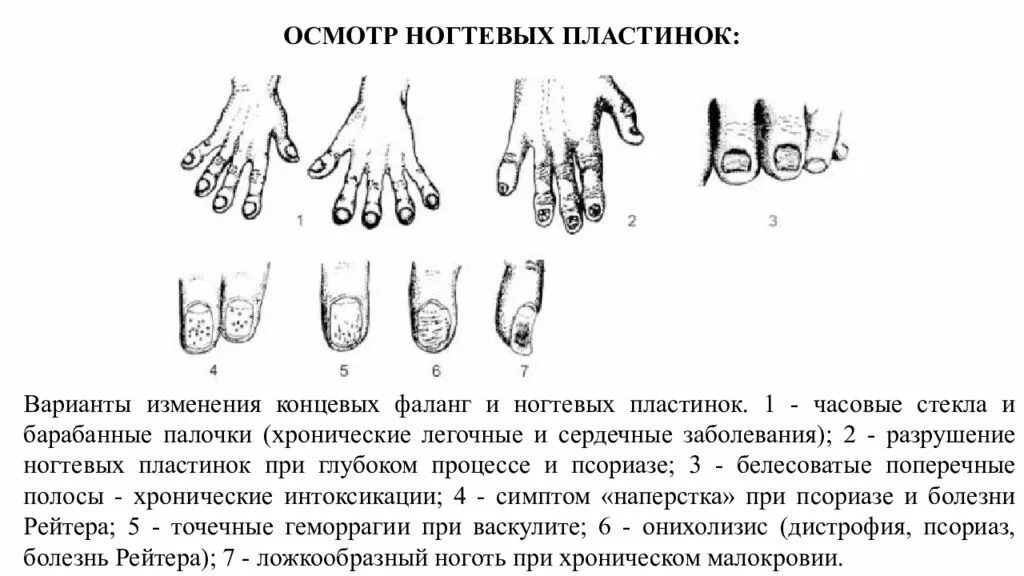 О чем говорят изменения ногтей. Осмотр ногтевых пластинок. изменения формы ногтей и концевых фаланг пальцев.