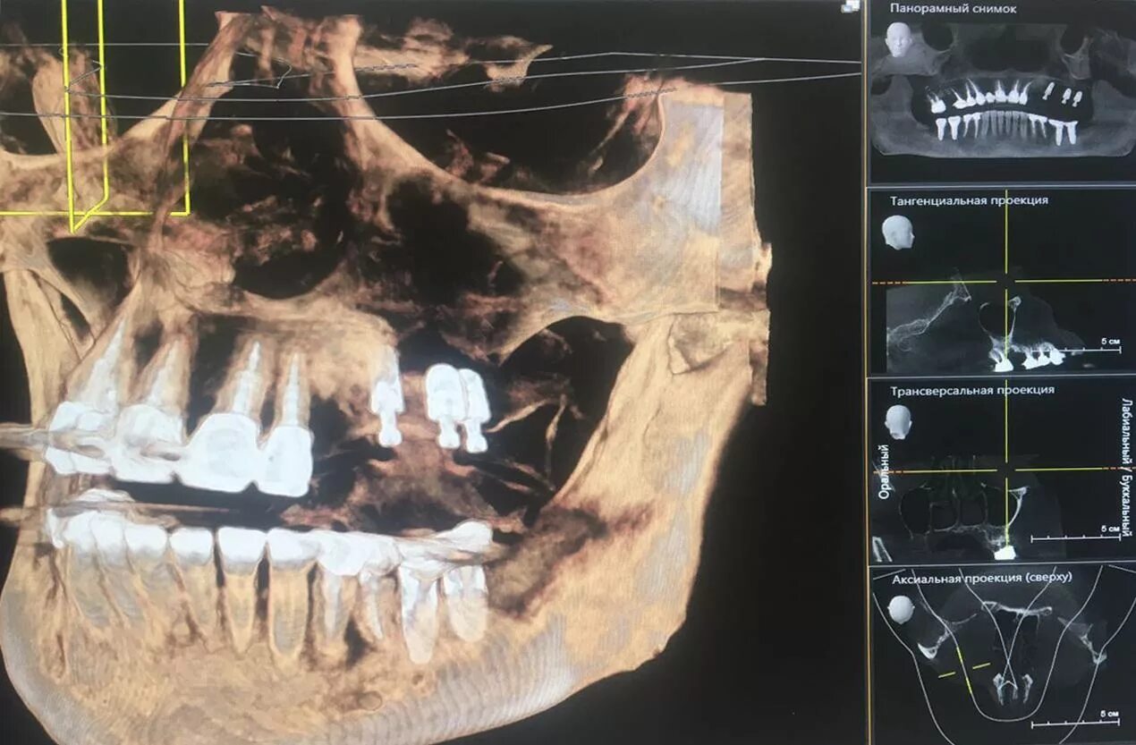 Снимок зубов видное. КЛКТ VATECH 12x8.5. Остеомиелит челюсти компьютерная томография.