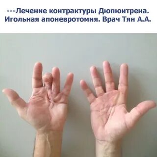 Синдром ладони