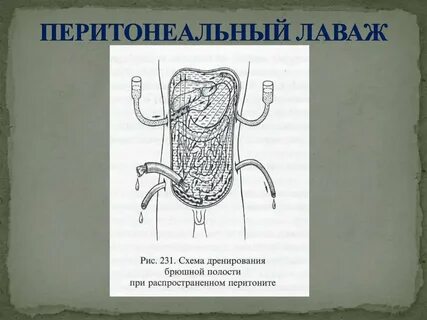 Брюшная полость лечим