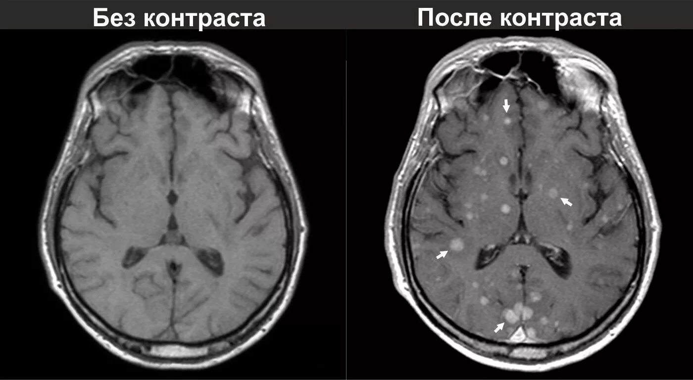 Мрт с седацией. Мрт головного мозга с контрастированием. Опухоль головного мозга на мрт без контраста. Опухоль головного мозга снимок мрт. Метастазы в головном мозге на мрт с контрастом.