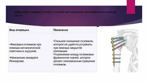 Лечение перелома без операции