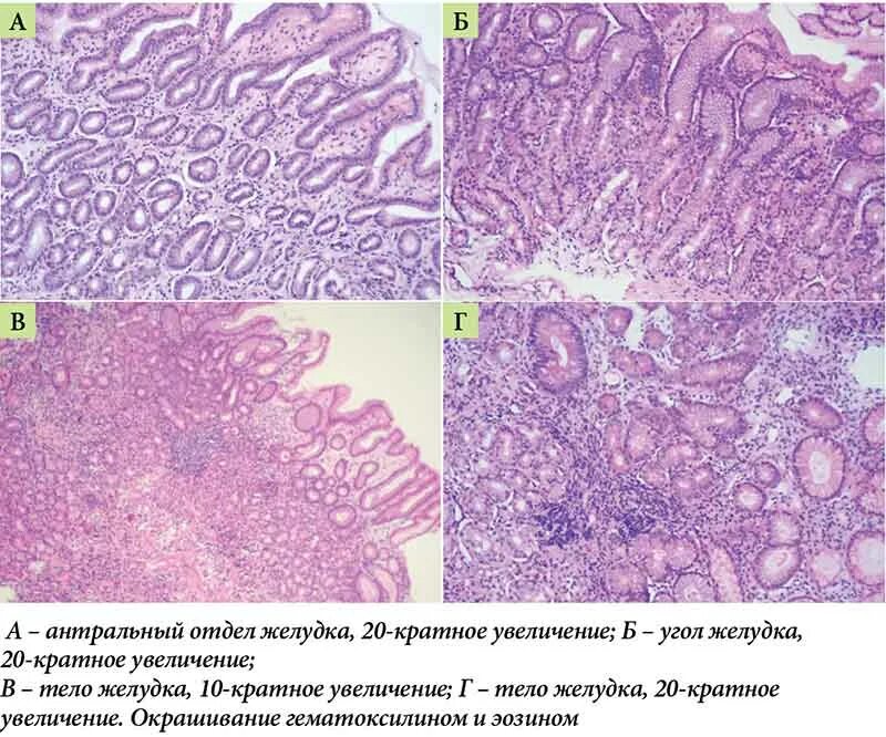 Фундальный атрофический гастрит. Атрофический гастрит патанатомия. Фундальный полип желудка гистология. Кишечная метаплазия гистология. Признаки атрофией слизистой оболочки